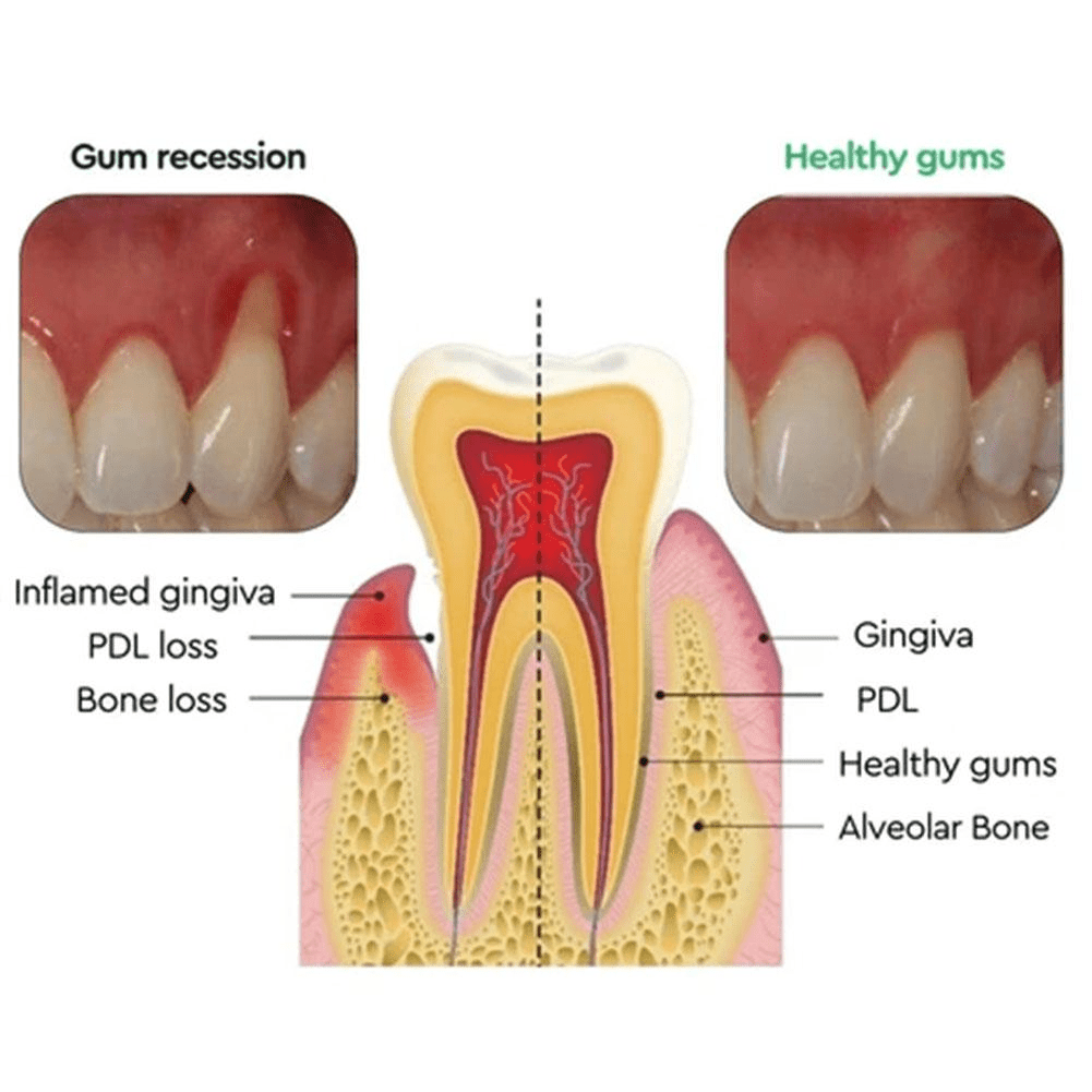 Can Receding Gums Really Regrow? Unveiling the Truth - Act Design Shop