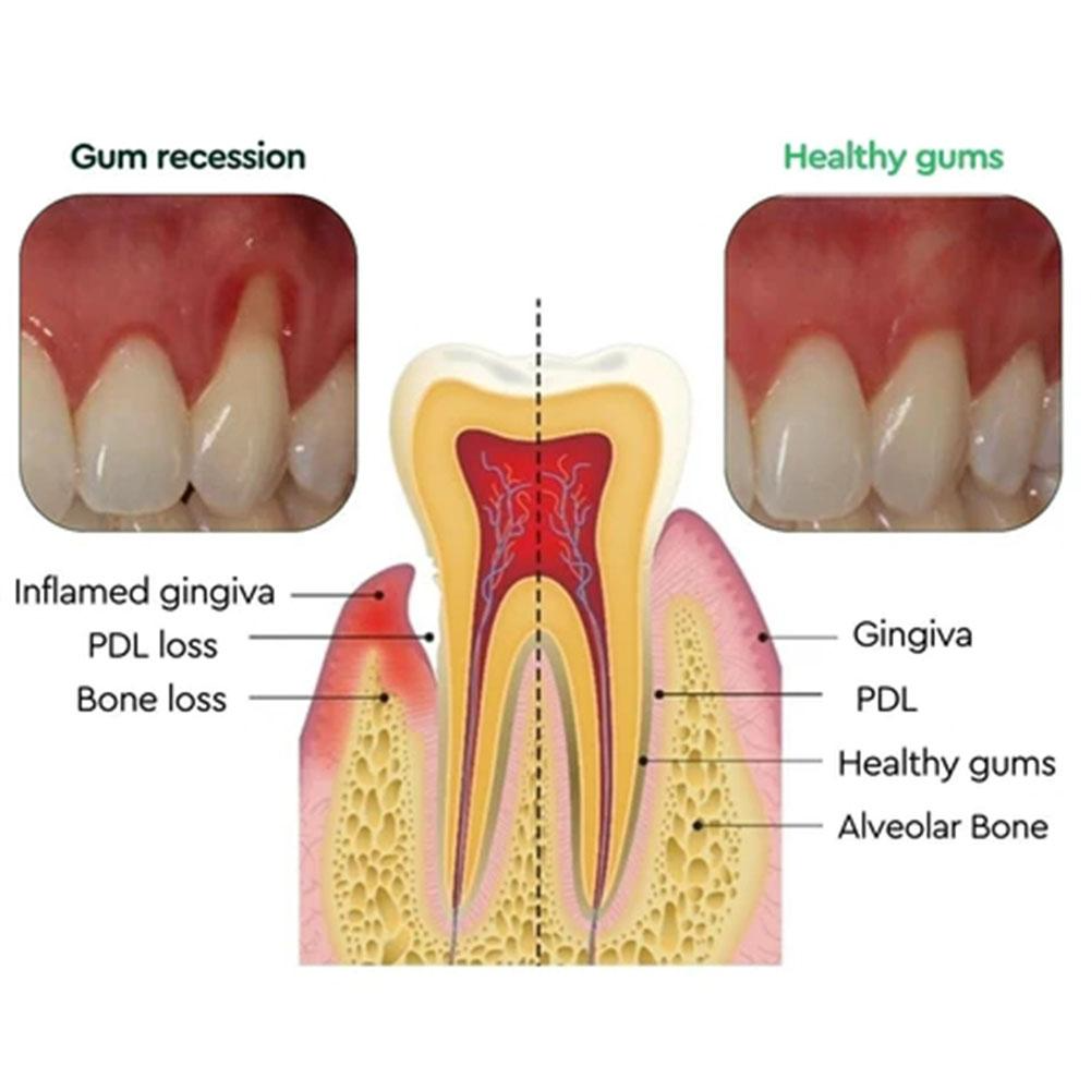 Can Receding Gums Really Regrow? Unveiling the Truth